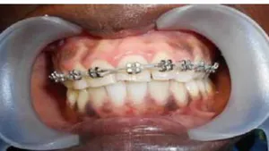 Prevalence and Treatment of Maxillary Incisivo-Canine Block Anomalies at the Donka National Hospital in Conakry