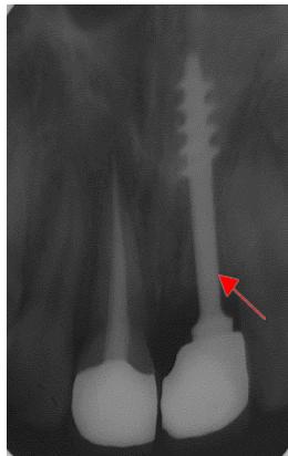 Immediate Functional Loading – Evaluation of Bicortical Screw Implants