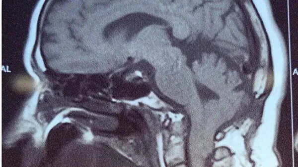 Evoked Brain Potentials in the Preoperative Diagnosis of Type 1 Chiari Malformation