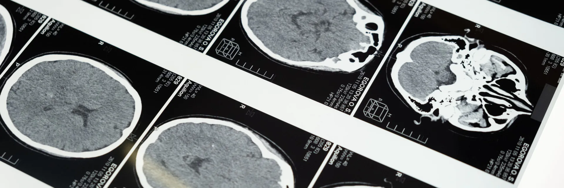 Posterior Reversible Encephalopathy Syndrome Secondary to Arterial Hypertension: A Case Report from Lubumbashi, Democratic Republic of Congo Banner