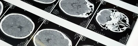 Posterior Reversible Encephalopathy Syndrome Secondary to Arterial Hypertension: A Case Report from Lubumbashi, Democratic Republic of Congo