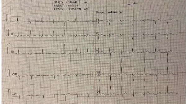 Seizure, an Explosive Effect of a Lightning Strike: A Case Report