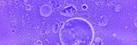 Lipedema and its Main Characteristics: A Literary Review