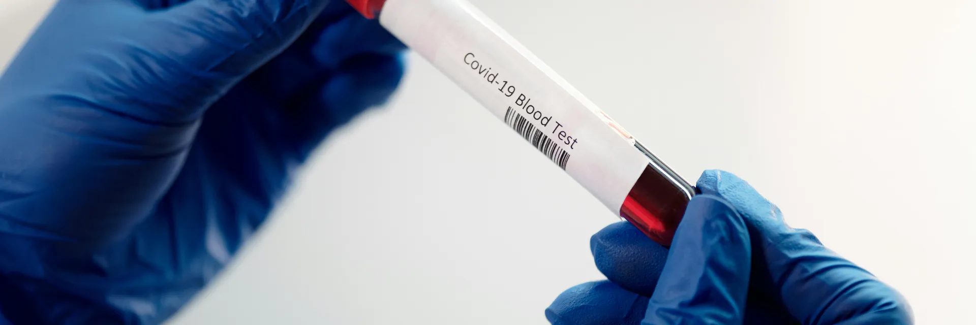 Evaluation of Surrogate Risk Factors for Severe Progression of COVID-19 in Tobacco Smoking Sub-Population and its Possible Amelioration by Immune Modulators Banner