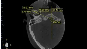 Influence of Tooth Loss and Malocclusions on Condylar Position: Analysis by Cone Beam Computed Tomography
