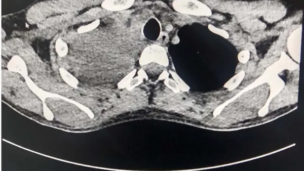 Massive Hemothorax Following Ultrasound-Guided Central Venous Catheterization in an Anesthetized Patient: A Case Report