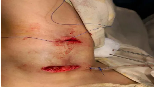 Incidence and Outcome of Second Branchial Cleft Anomalies: A Three Years Experience and Appreciation