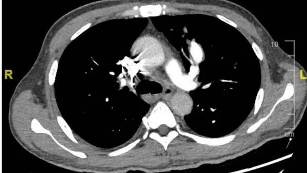 An Unusual Manifestation of Hughes-Stovin Syndrome – Case Report