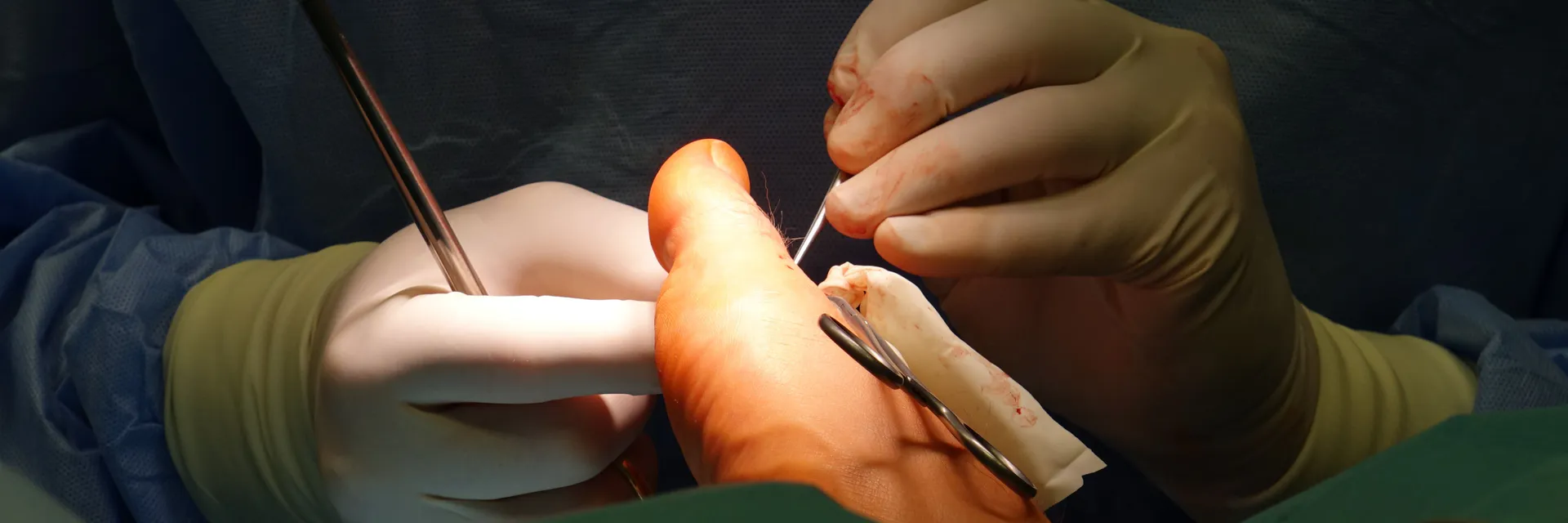Chronic Dislocation of the 5th Metatarsophalangeal Joint with Physeal Injury of Metatarsal: A Case Report Banner