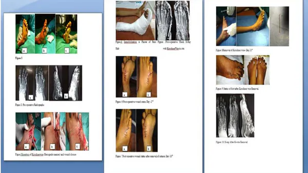 Chronic Dislocation of the 5th Metatarsophalangeal Joint with Physeal Injury of Metatarsal: A Case Report
