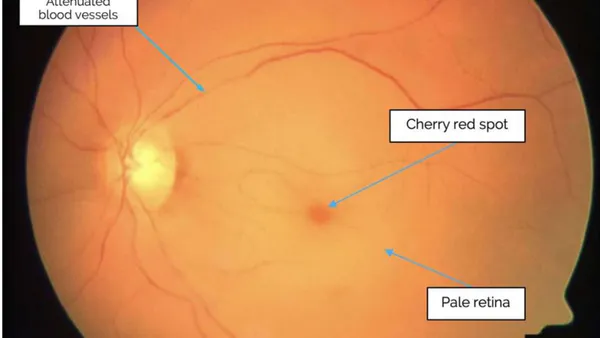 Central Retinal Artery Occlusion and Its Visual Prognosis In An African Population-Analytical Comparative  Retrospective Study