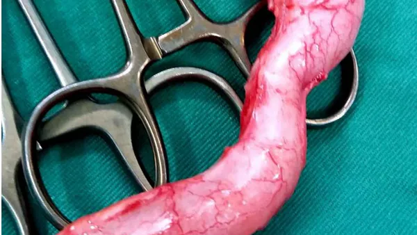 Treatment and Evolution of Appendicular Mucoceles  in Six Casesa