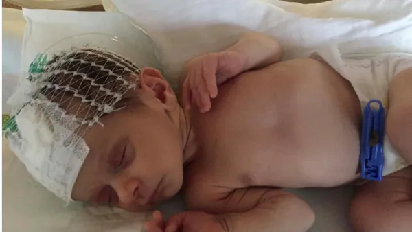 Severe Hypernatremic Dehydration in a Neonate