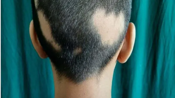 Co-Occurrence of Lichen Planus and Alopecia Areata: A Possible Role of Plasmacytoid Dendritic Cells