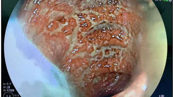 Association between Systemic Lupus Erythematosus and Refractory Ulcerative Colitis: What are our Therapeutic Options?