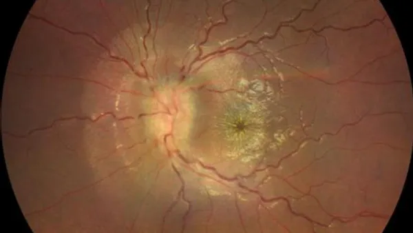 Unilateral Idiopathic Neuroretinitis Following Pfizer-BioNTech COVID-19 Vaccine; A Case Report