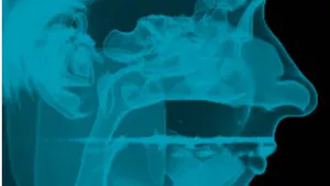 Orthodontics Intrication To Maxillo-Facial Surgery Preparation of Cases with Obtrusive Syndrome of Apnea