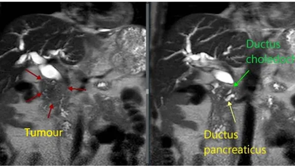 Advancements in Morphological Verification: Evaluating a Novel Method for Pancreatic and Distal Bile Duct Tumour