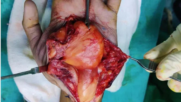 The Enigma of Lipofibromatous Hamartoma: A Deep Dive into a Rare Pathology