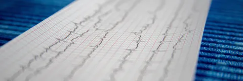 The Role Of Hemolysis In The Development Of Arrhythmias In Patients With Ischemic Heart Disease After Coronary Artery Bypass Grafting Under Artificial Circulation