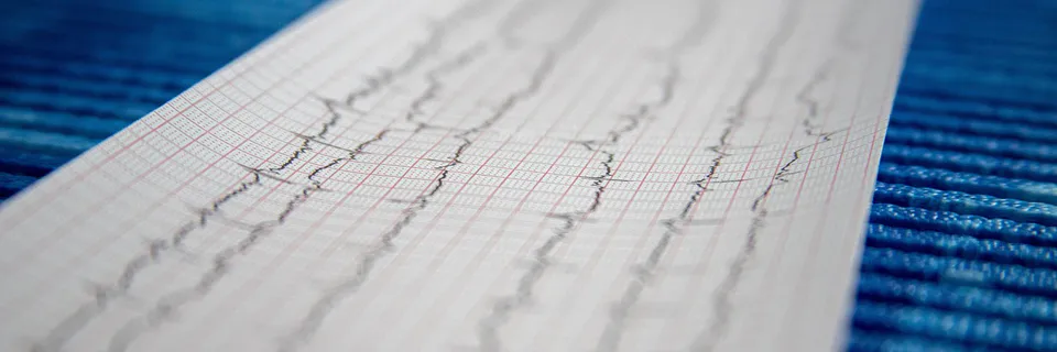 The Role Of Hemolysis In The Development Of Arrhythmias In Patients With Ischemic Heart Disease After Coronary Artery Bypass Grafting Under Artificial Circulation Banner