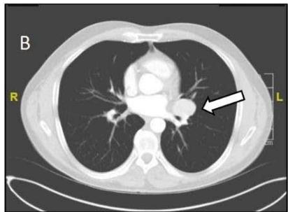 Parenchymal Sparing Surgery With Minimally Invasive Approach In Castleman’s Disease: Case Report