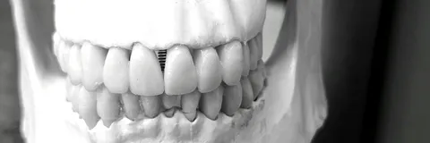 Comparative Outcomes of Two-Point Versus Three-Point Microplate Fixation in Zygomaticomaxillary Complex Fractures
