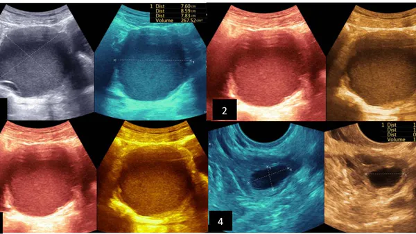 Percutaneous Radio-Guided Chemical Ablation with Absolute Ethanol of Cystic and Solid Lesions in Kinshasa Hospital Environments