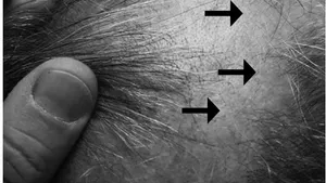 Cutaneous Pseudolymphoma: A Case Report