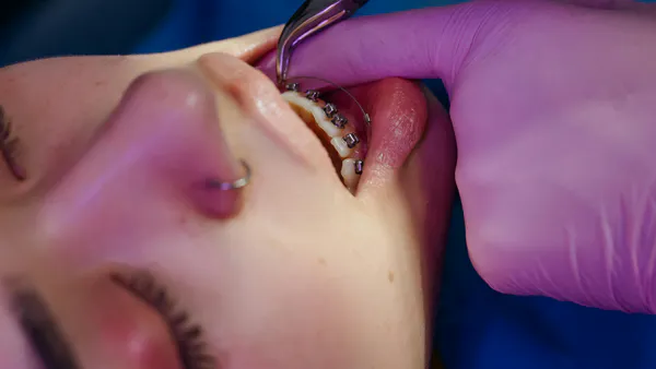 Extraction Treatment of Severe Bimaxillary Incisor Protrusion in a High-Angle Class II Patient: Three-Dimensional Torque Control Using ART and Ricketts Bioprogressive Mechanics