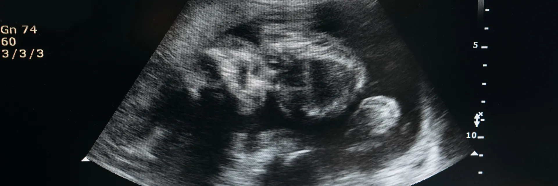 A Retrospective Study: Twin Pregnancy at Tertiary Care Center, Maternal and Perinatal Outcome Banner