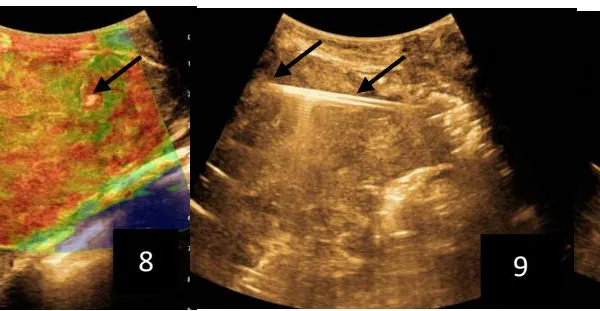 Safety and Diagnostic Accuracy of Biopsy of Targeted Splenic Lesions Under Ultrasound Guidance Using the Multiple-Pass Technique Without Co-Axial in Kinshasa Hospitals