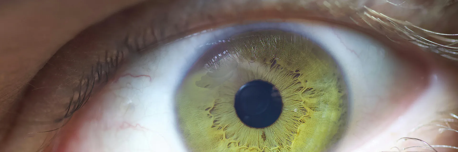 Management of Retinopathy of Prematurity in an African Population- An Analytical Retrospective Comparative Study Banner