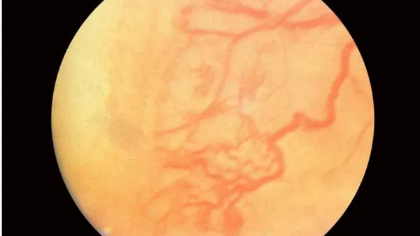 Management of Retinopathy of Prematurity in an African Population- An Analytical Retrospective Comparative Study
