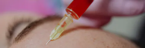 Goldincision – A Multifactor Approach To Cellulite Treatment