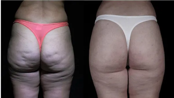 Goldincision – A Multifactor Approach To Cellulite Treatment