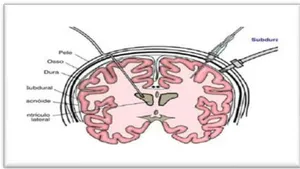 Intracranial Hypertension and the use of External Ventricular Drain – EVD: Correct Management Avoids Complications