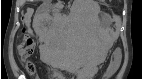 Unusual Case of Large Conglomerate Mass in Abdomen