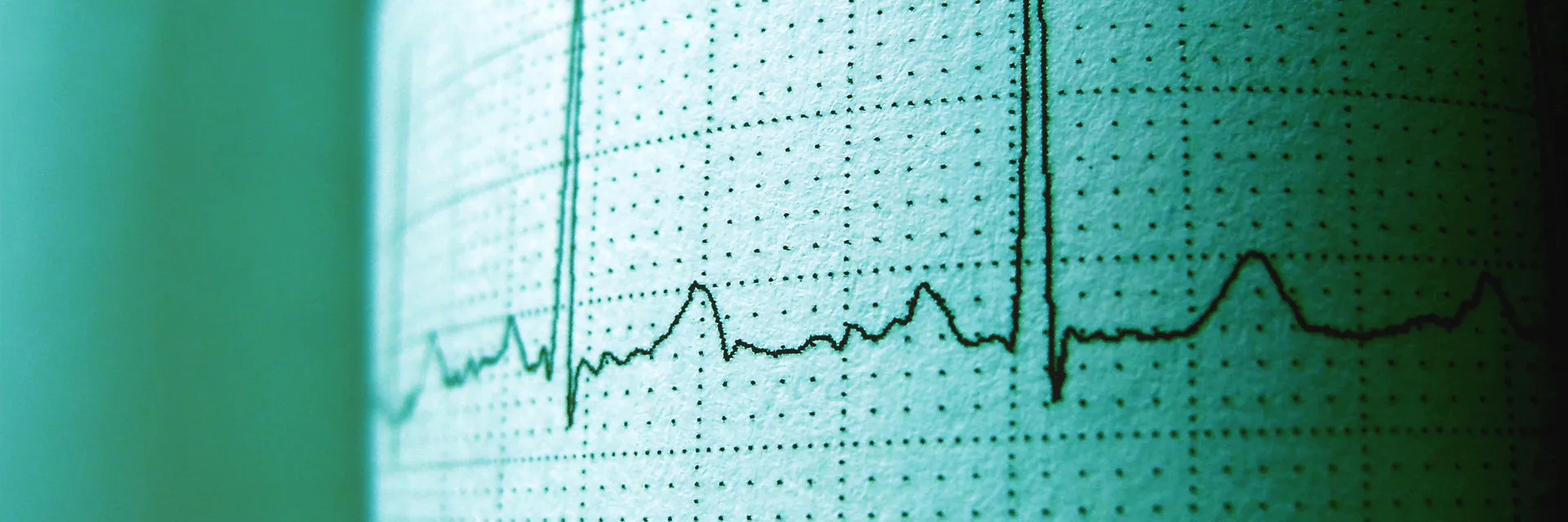 Significance of Positive Cardiac Troponin in Patients with Normal ECG: A Comparative Analysis Banner