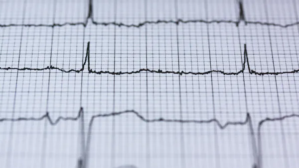 Significance of Positive Cardiac Troponin in Patients with Normal ECG: A Comparative Analysis