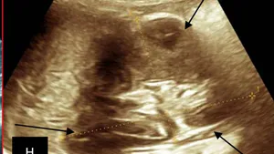 Ultra Sonographic Profile of Nephroblastoma at the University Clinics of Kinshasa