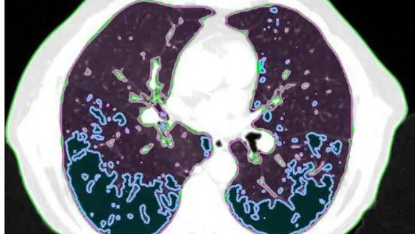 Are Known Lung Dose Limits Valid for all Patients?