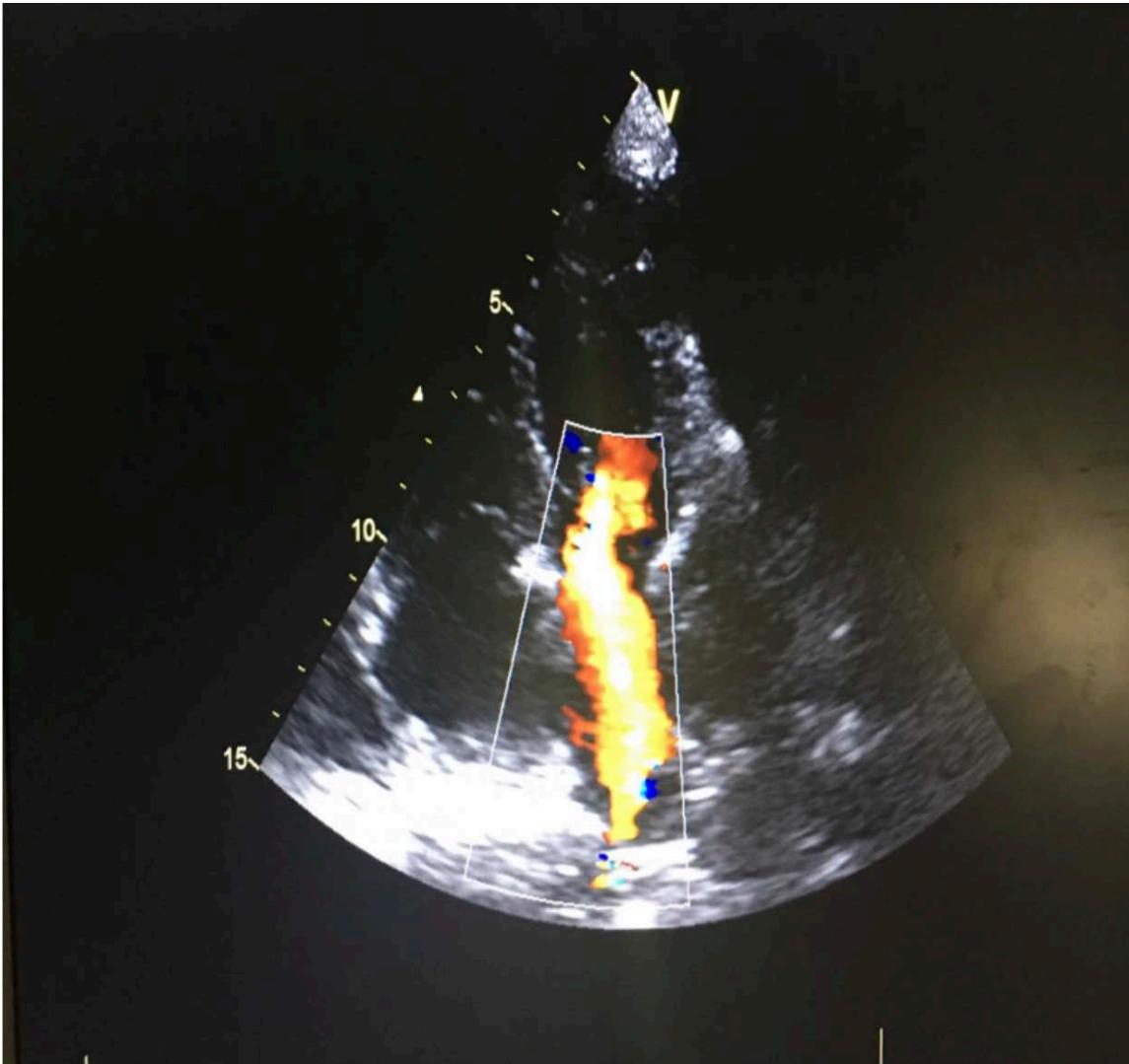 Pulmonary Vein Thrombosis Complicating Lung Cancer , Case Report and Literature Review