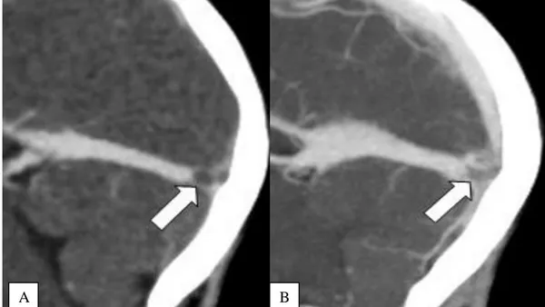 Imaging Contribution in Headache and Cerebral Venous Thrombosis (CVT)