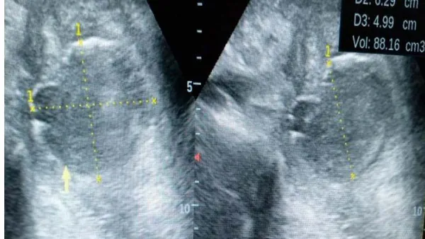 Appendiceal Abscess in a Young Adult: A Review of the Ultrasonographic Findings: A Case Report